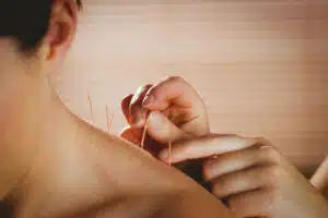 woman receiving acupuncture on her shoulder